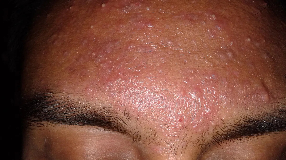 Acne