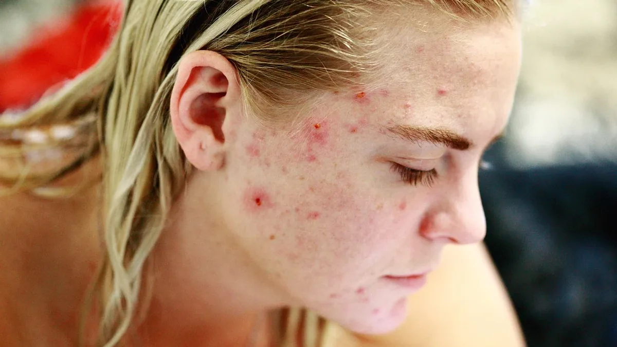 Hormonal Acne