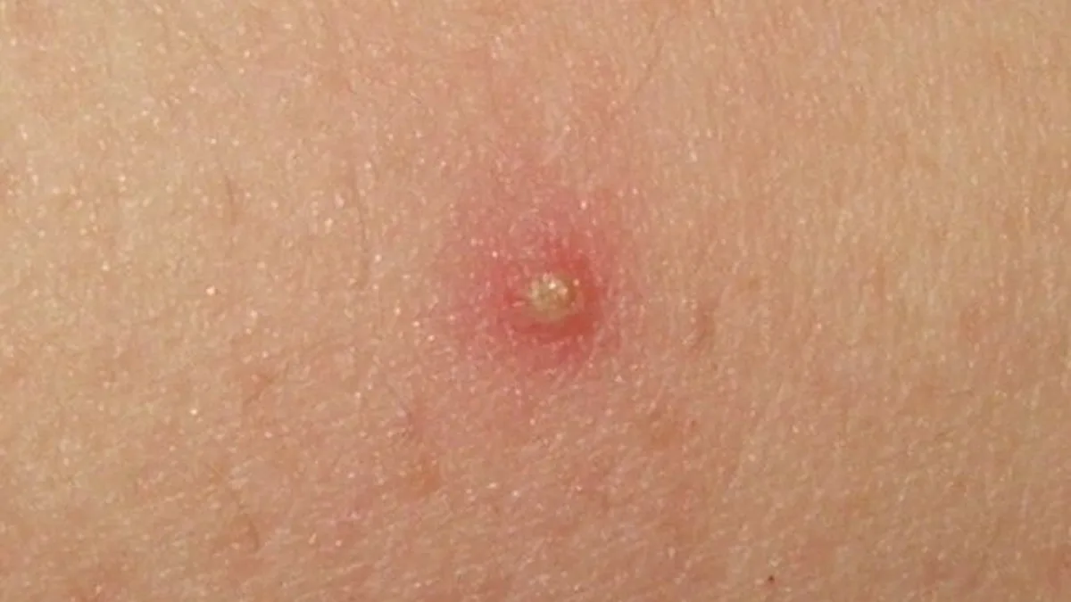 Malassezia Folliculitis, Often Called Fungal Acne