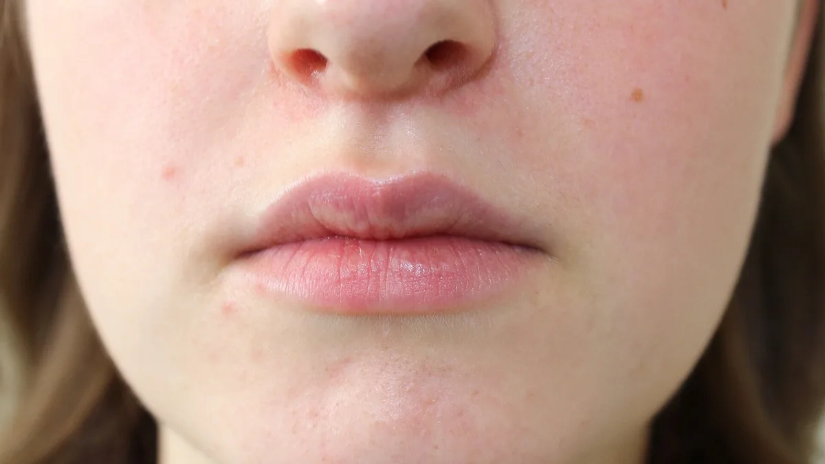 Perioral Dermatitis