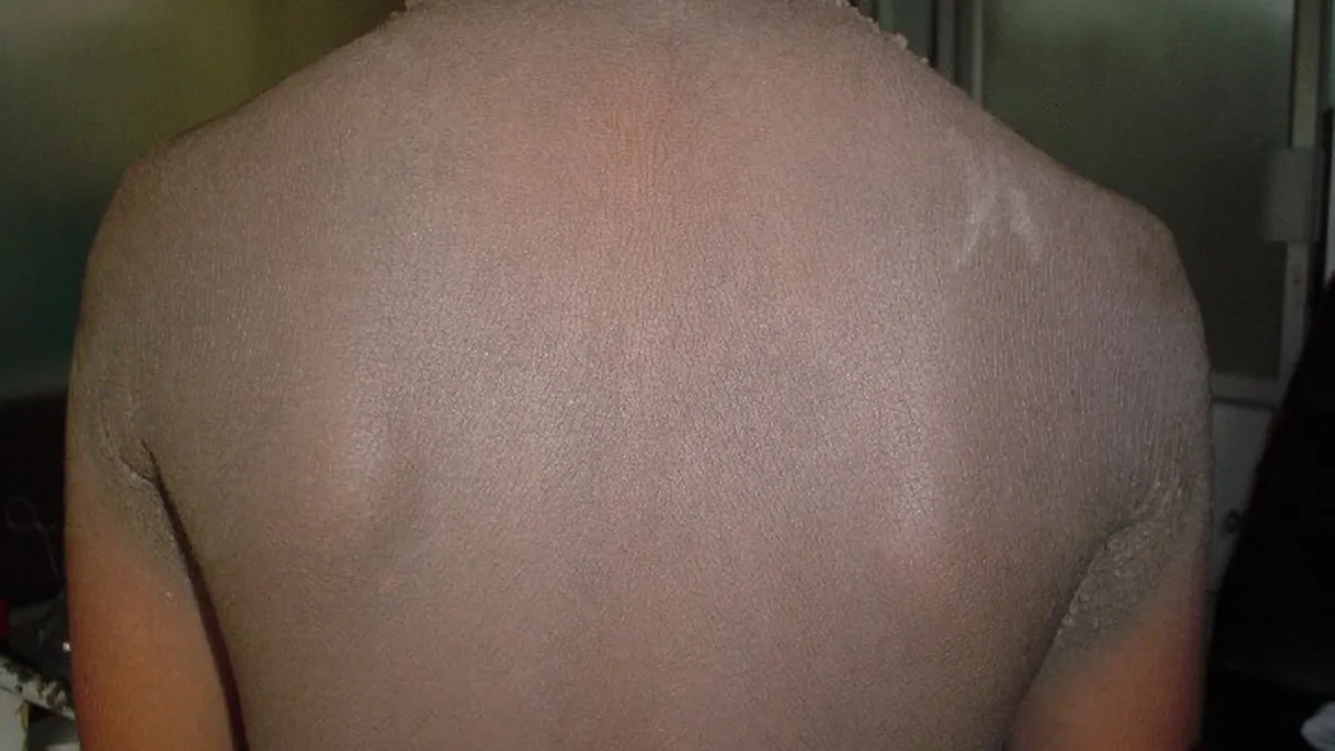 Post Inflammatory Hyperpigmentation