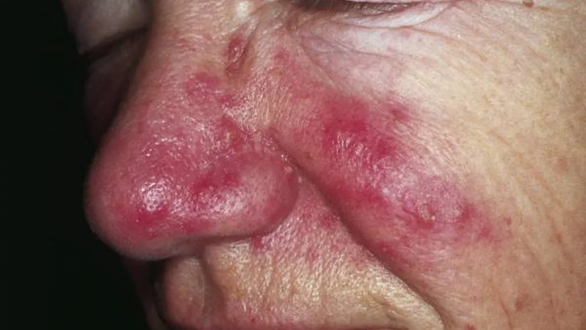 Rosacea